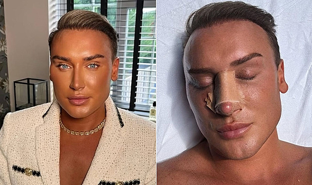 Muž má za sebou sto zákroků v obličeji. Chce docílit dokonalé krásy